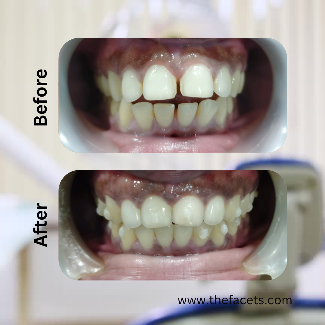 Before and after clear aligner treatment result 11